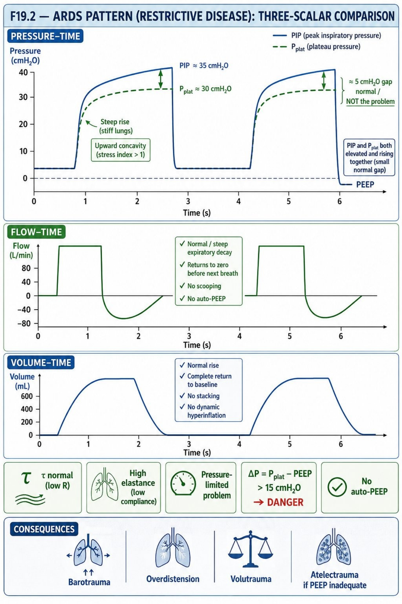 Hình MVG-F19-02. Mẫu đồ họa hạn chế điển hình ở ARDS. Nguồn: Mastering Ventilator Graphics, trang PDF 110.